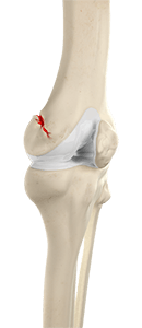 Knee Fracture