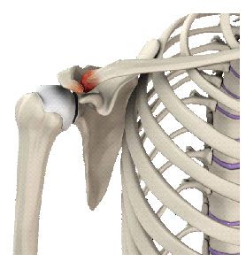 Acromioclavicular (AC) Arthritis