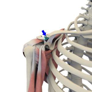 AC Joint Resection