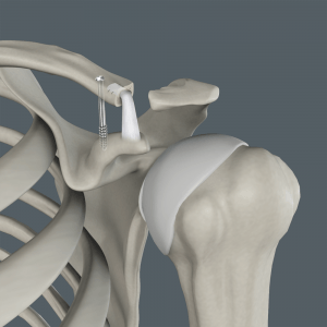 Acromioclavicular (AC) Joint