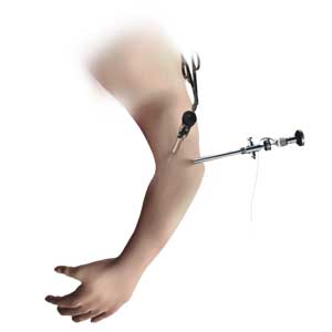 Elbow Arthroscopy