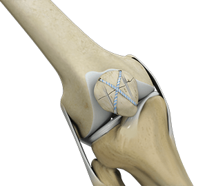 Knee Fracture Surgery