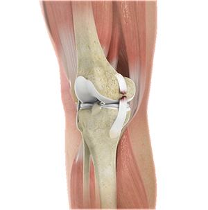 acl-tear