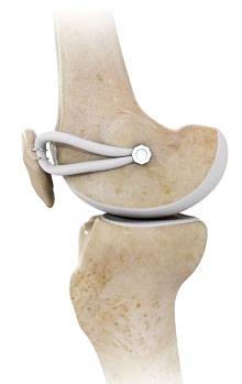 glenoid-fracture-n