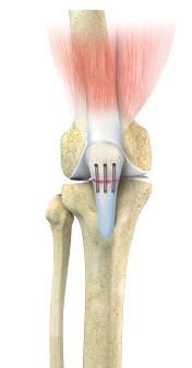 Patellar Tendon Repair