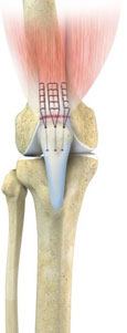 Quadriceps Tendon Repair