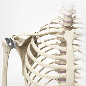 Shoulder Joint Replacement