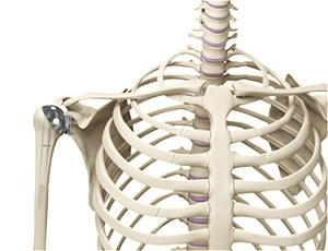 Shoulder Joint Replacement