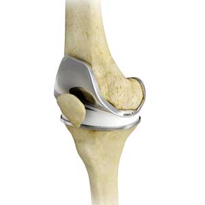 Total Knee Replacement